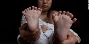 Το βρέφος με τα 31 δάχτυλα