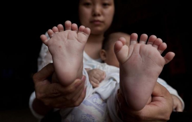 Το βρέφος με τα 31 δάχτυλα