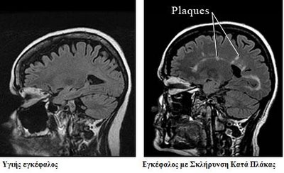 Νέο υποσχόμενο πειραματικό φάρμακο για τη σκλήρυνση κατά πλάκας