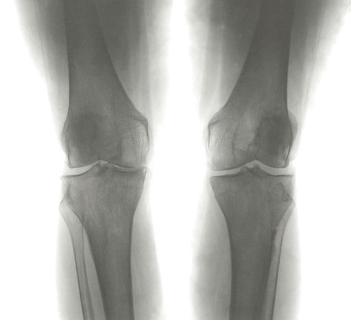 Θεραπεία xρόνιας αρθρίτιδας με ένεση ραδιοϋμενόλυσης