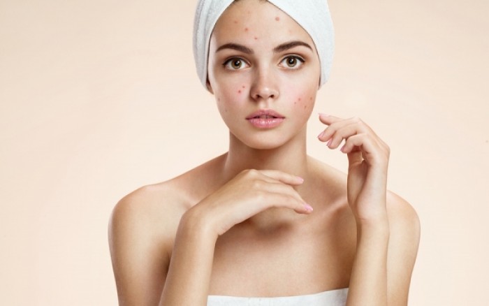 Ακμή: Αυτές είναι οι σύγχρονες οδηγίες για την αντιμετώπισή της