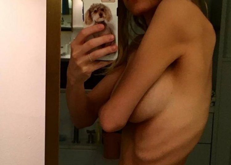 Διάσημη ηθοποιός φωτογραφίζει τα πλευρά της και αποκαλύπτει το πρόβλημα υγείας της