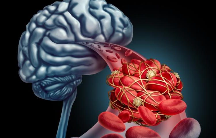 Ανεύρυσμα εγκεφάλου: Μην αγνοήσετε τα «αθώα» πρώιμα συμπτώματα