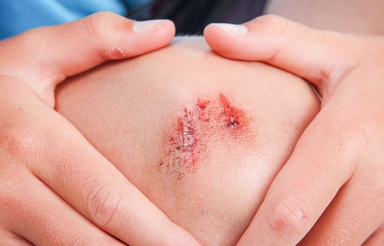 Κοψίματα, εκδορές, γρατζουνιές: Αντιμετώπιση με 5 θεραπείες από φυσικά υλικά