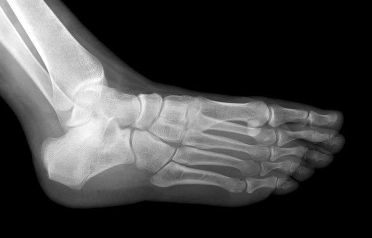 Πόνοι στα πέλματα: Οι κοινές αιτίες και πώς αντιμετωπίζονται