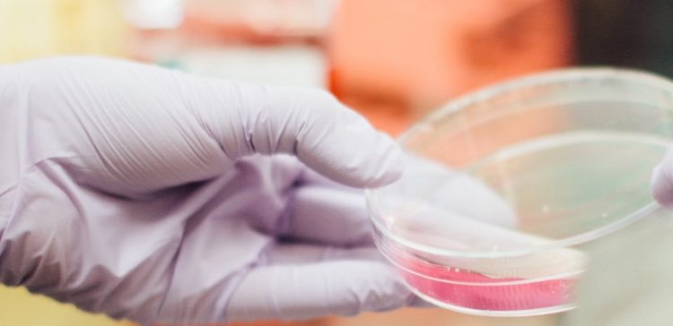 Ελληνίδα επικεφαλής σε σημαντική μελέτη που αποκαλύπτει νέα διάγνωση για τη νόσο Αλτσχάιμερ