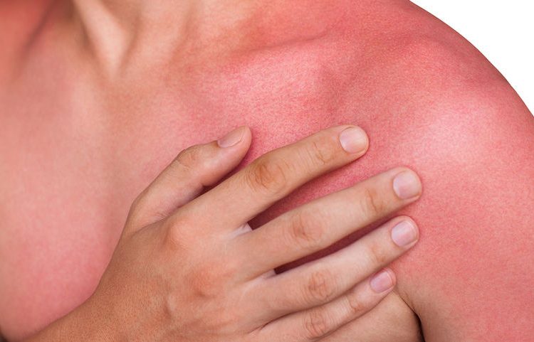 Τι συμβαίνει στο δέρμα όταν παθαίνουμε έγκαυμα;