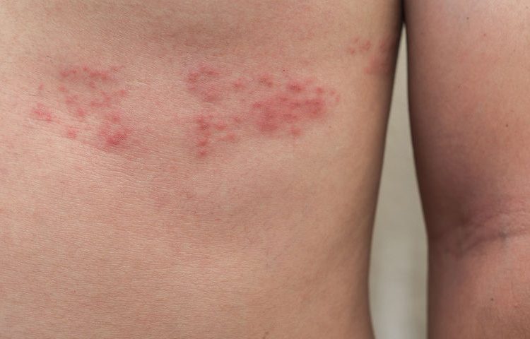 Έρπης ζωστήρας: Πόσο αυξάνει τον κίνδυνο εμφράγματος και εγκεφαλικού