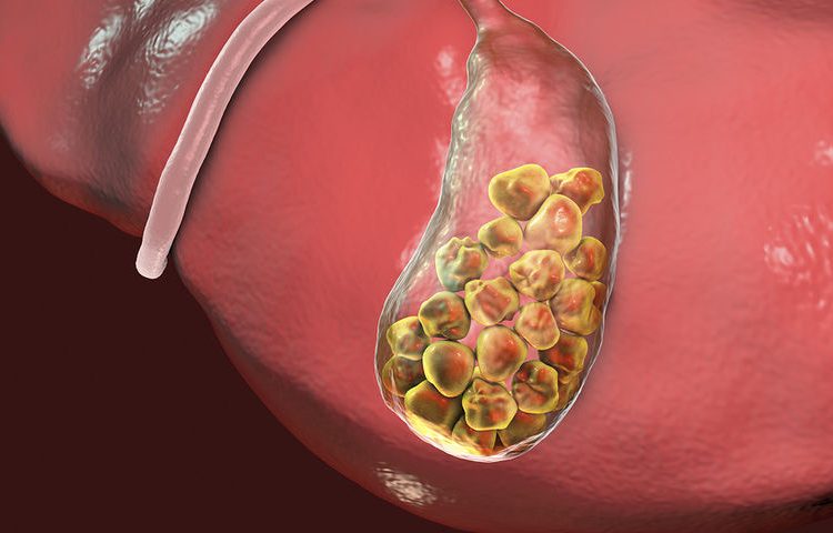 Πέτρες στη χολή: Μειώστε τον κίνδυνο με γυμναστική!