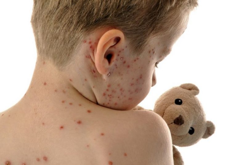 «Ακάθεκτη» η ιλαρά: Αγγίζει τα 1.000 ο αριθμός των κρουσμάτων – 167 κρούσματα έχουν αναφερθεί σε Αχαΐα, Ηλεία, Αιτωλοακαρνανία