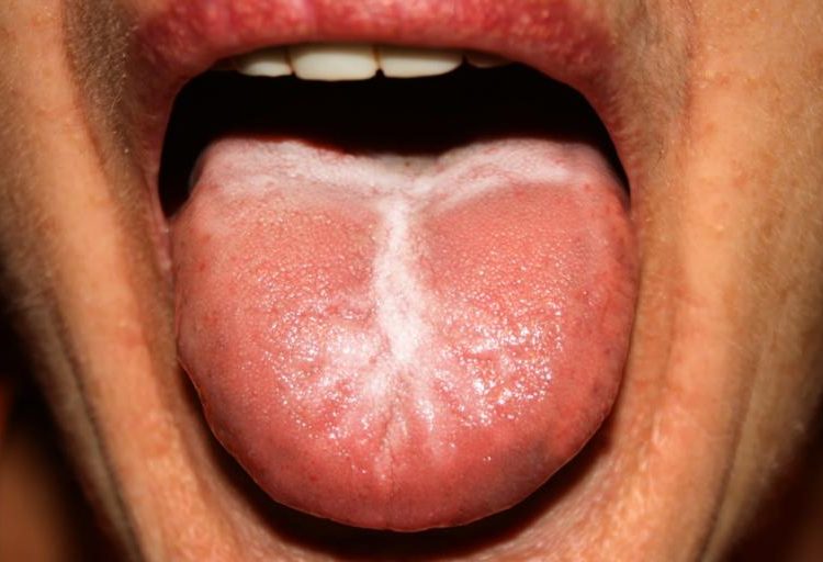 Λευκή γλώσσα: Γιατί συμβαίνει – Πότε είναι ανησυχητικό