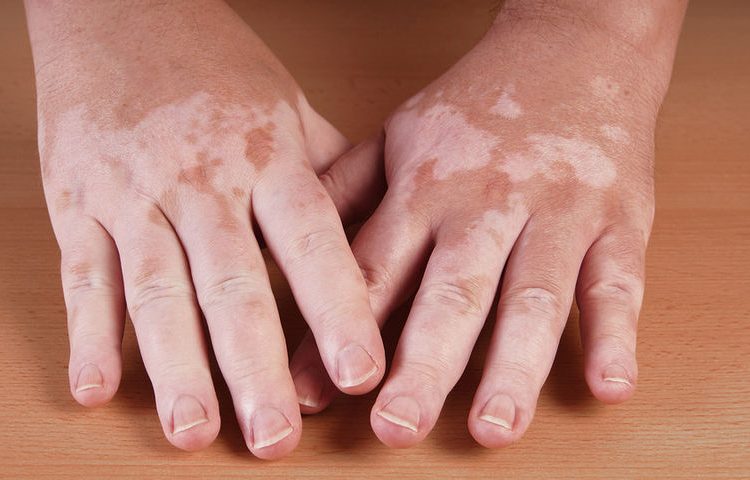 Λεύκη: Πως να προστατευτείτε το καλοκαίρι