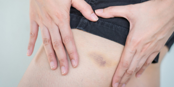 Προσοχή αν κάνετε μελανιές «χωρίς λόγο» – Τι μπορεί να σας συμβαίνει