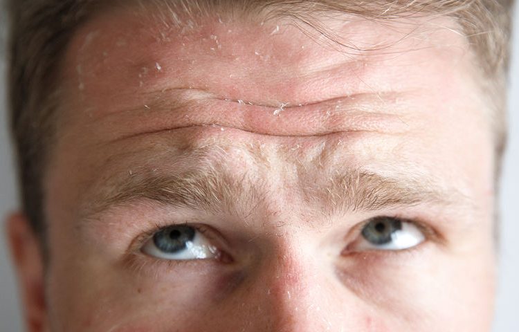 Κοκκίνισμα στο πρόσωπο: Οι 7 «ένοχες» παθήσεις