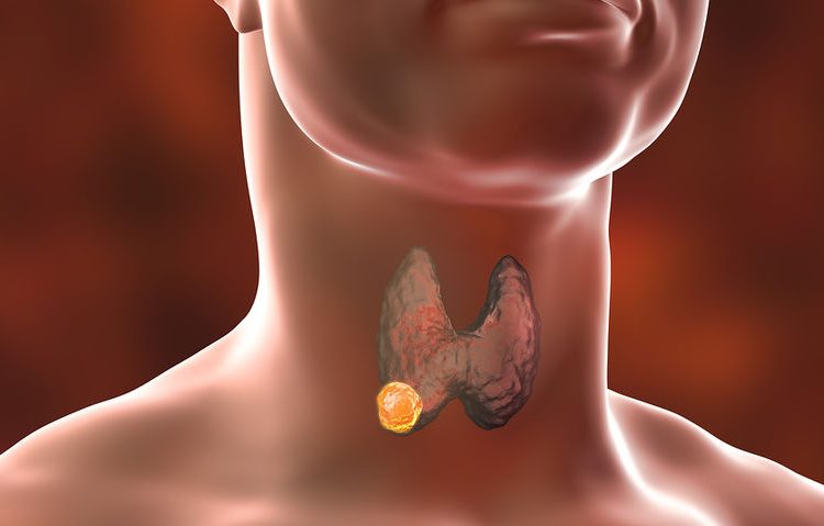 Θυρεοειδής: Πότε χρειάζεται εγχείρηση