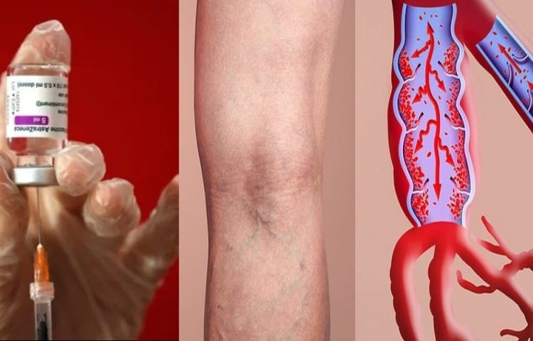 Νέο περιστατικό θρόμβωσης σε 20χρονη μετά το εμβόλιο