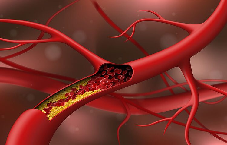 Χοληστερίνη: Τα σημάδια στα πόδια που δεν πρέπει να αγνοήσετε