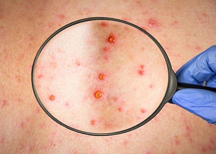 Ευλογιά των πιθήκων: Στην Αθήνα μεταφέρθηκε από την Κεφαλονιά το πρώτο κρούσμα στην Ελλάδα