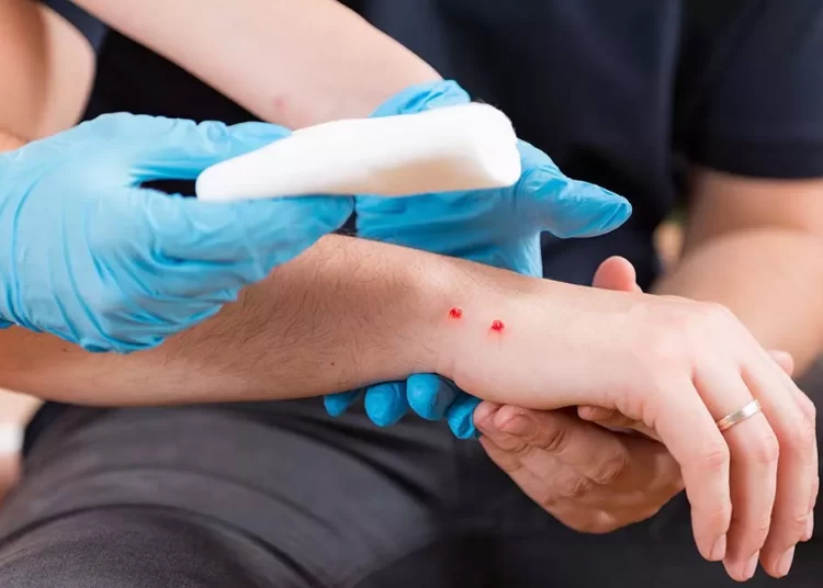 Δάγκωμα φιδιού: Τι να κάνετε σε περίπτωση που σας συμβεί – Ενημερωθείτε