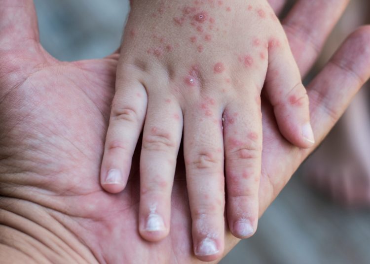 Ηλεία: Έξαρση του ιού Κοξάκι στα παιδιά-Τι να προσέξουν οι γονείς