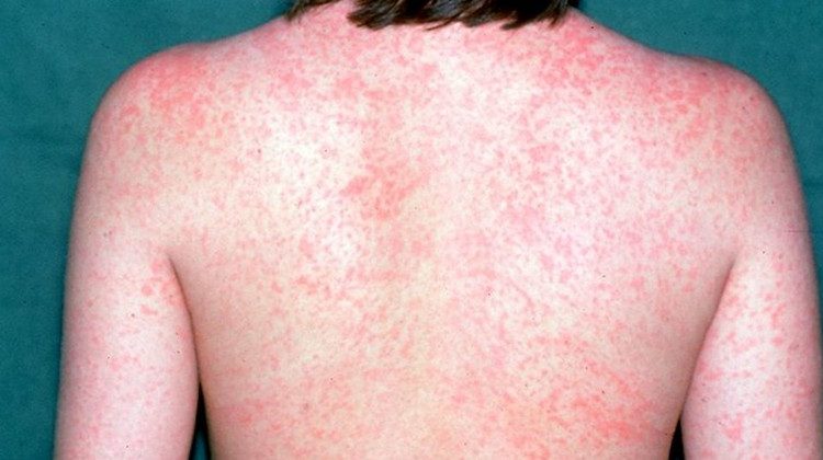 Ελλάδα: Δεν εμβολιάζονται και η Ιλαρά επελαύνει-Αυξήσεις κρουσμάτων