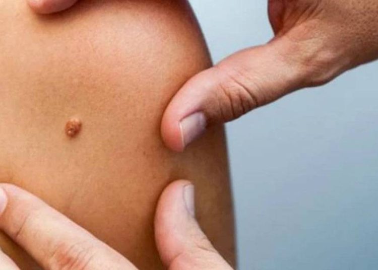 Καρκίνος κονδυλωμάτων: Εμβολιάζουμε τα παιδιά για πρόληψη