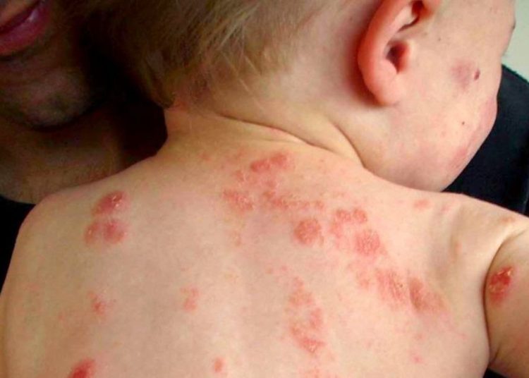 Καμπανάκι ΠΟΥ για ιλαρά: Έκρηξη με 56.634 κρούσματα σε 3 μήνες