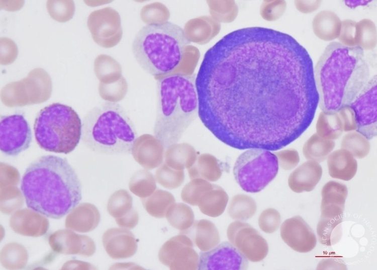 Προσοχή στον Παρβοϊό: Τι να γνωρίζουν γονείς & παιδιά