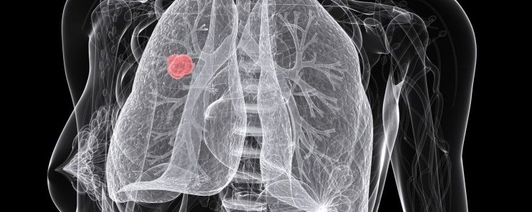 Ελλάδα: Οικονομικά προβλήματα για καρκινοπαθείς-Ασύμφορη η θεραπεία