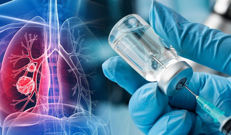 Ιστορικό επίτευγμα: Άρχισαν οι δοκιμές του εμβολίου για τον καρκίνο του πνεύμονα