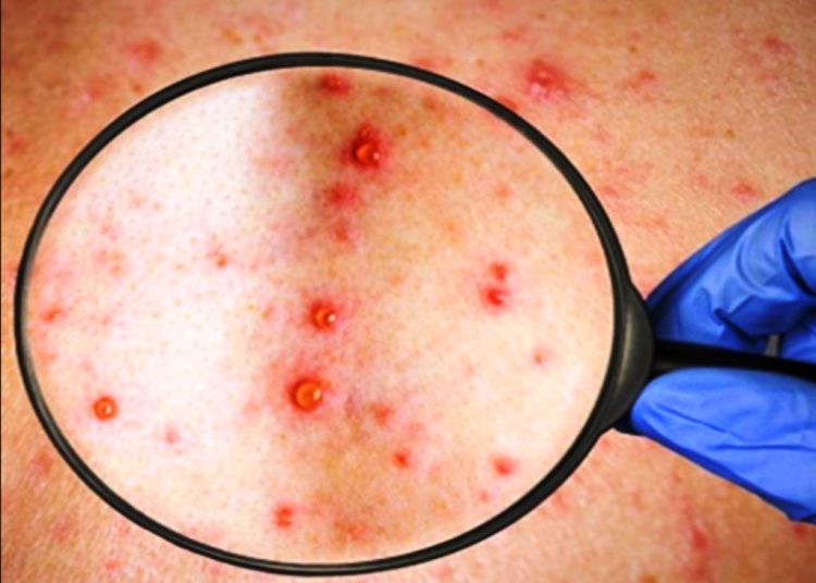 Ευλογιά των πιθήκων: Ανησυχία στην Ευρώπη μετά το κρούσμα στη Σουηδία