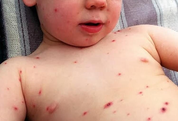 Ιλαρά: Ραγδαία αύξηση κρουσμάτων στην Ευρώπη-Τι γίνεται στην Ελλάδα