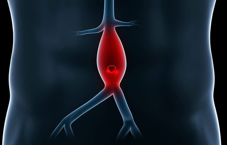 Καινοτόμο εργαλείο για ανεύρυσμα κοιλιακής αορτής φτιάχνουν Έλληνες επιστήμονες