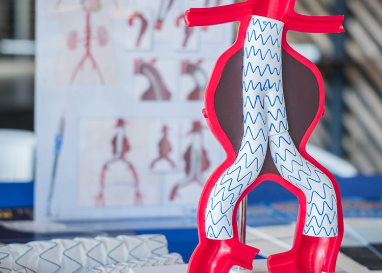 Ανεύρυσμα: Το τεστ του αντίχειρα που προμηνύει αυξημένο κίνδυνο