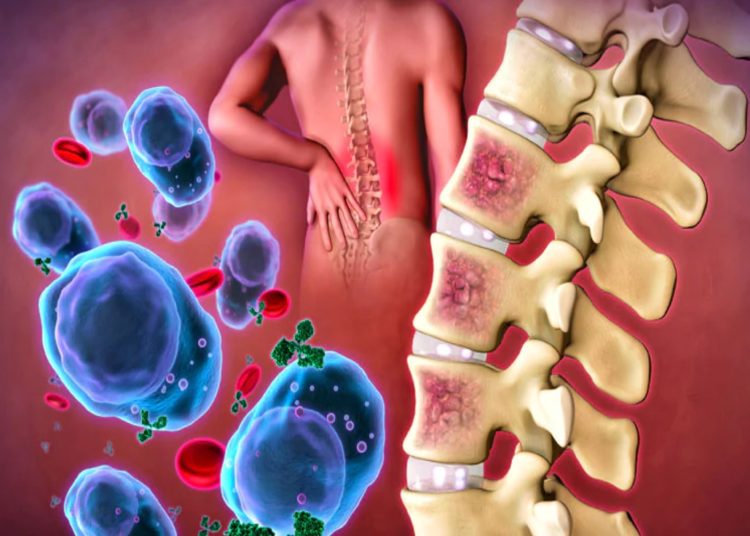 Πολλαπλό μυέλωμα: Πρωτοπορεί στην θεραπεία η Ιατρική Σχολή ΕΚΠΑ