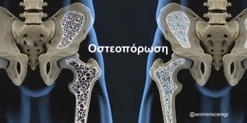 Οστεοπόρωση: Πέντε πράγματα να κάνουμε κάθε πρωί για γερά οστά