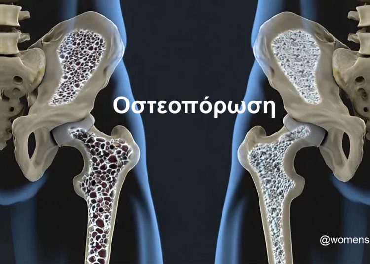 Οστεοπόρωση: Πέντε πράγματα να κάνουμε κάθε πρωί για γερά οστά